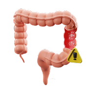 Ilustración 3D del colon con marcas de advertencia señalando posibles zonas afectadas.